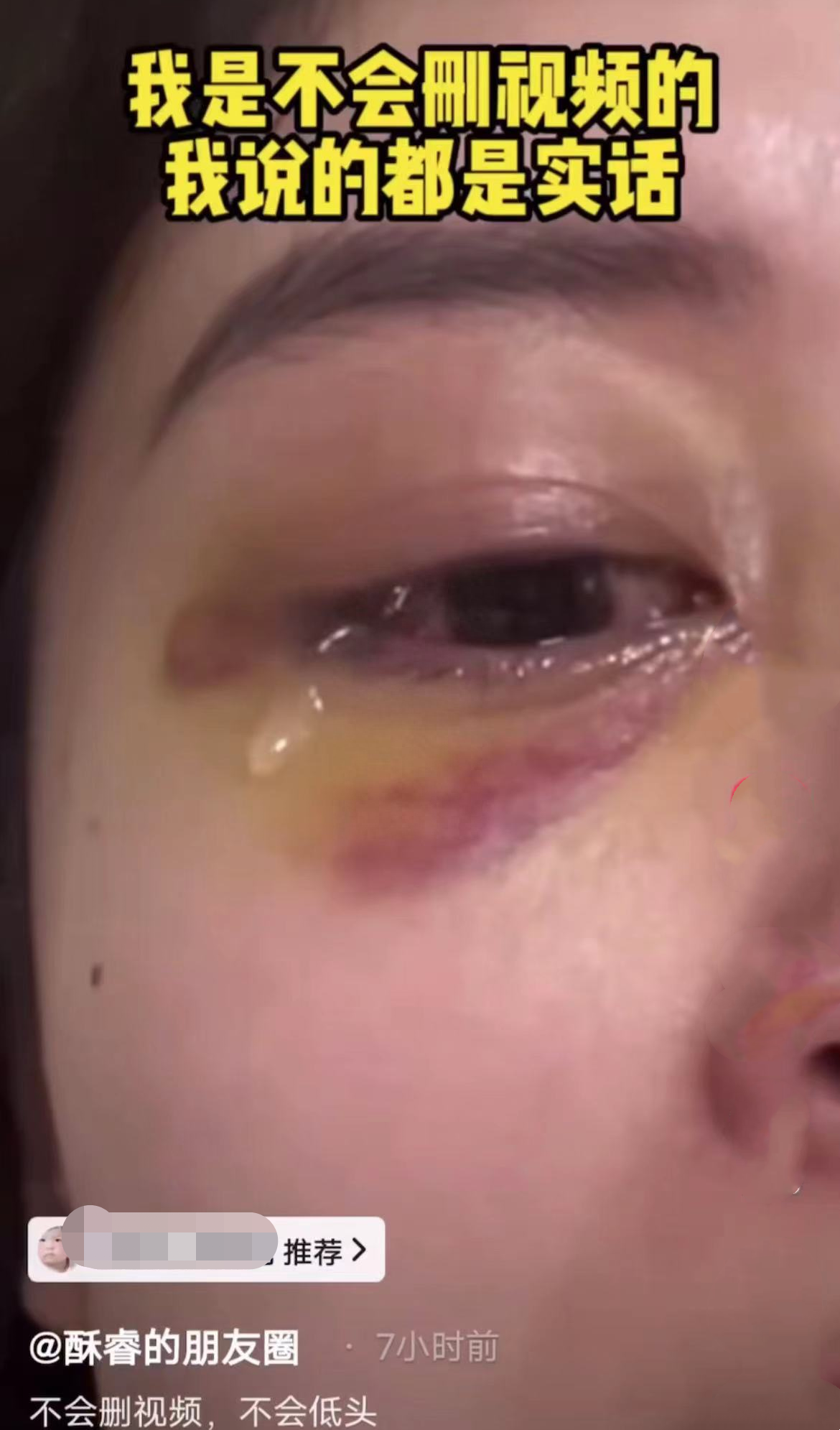 脸部受伤险毁容,报案后偃旗息鼓