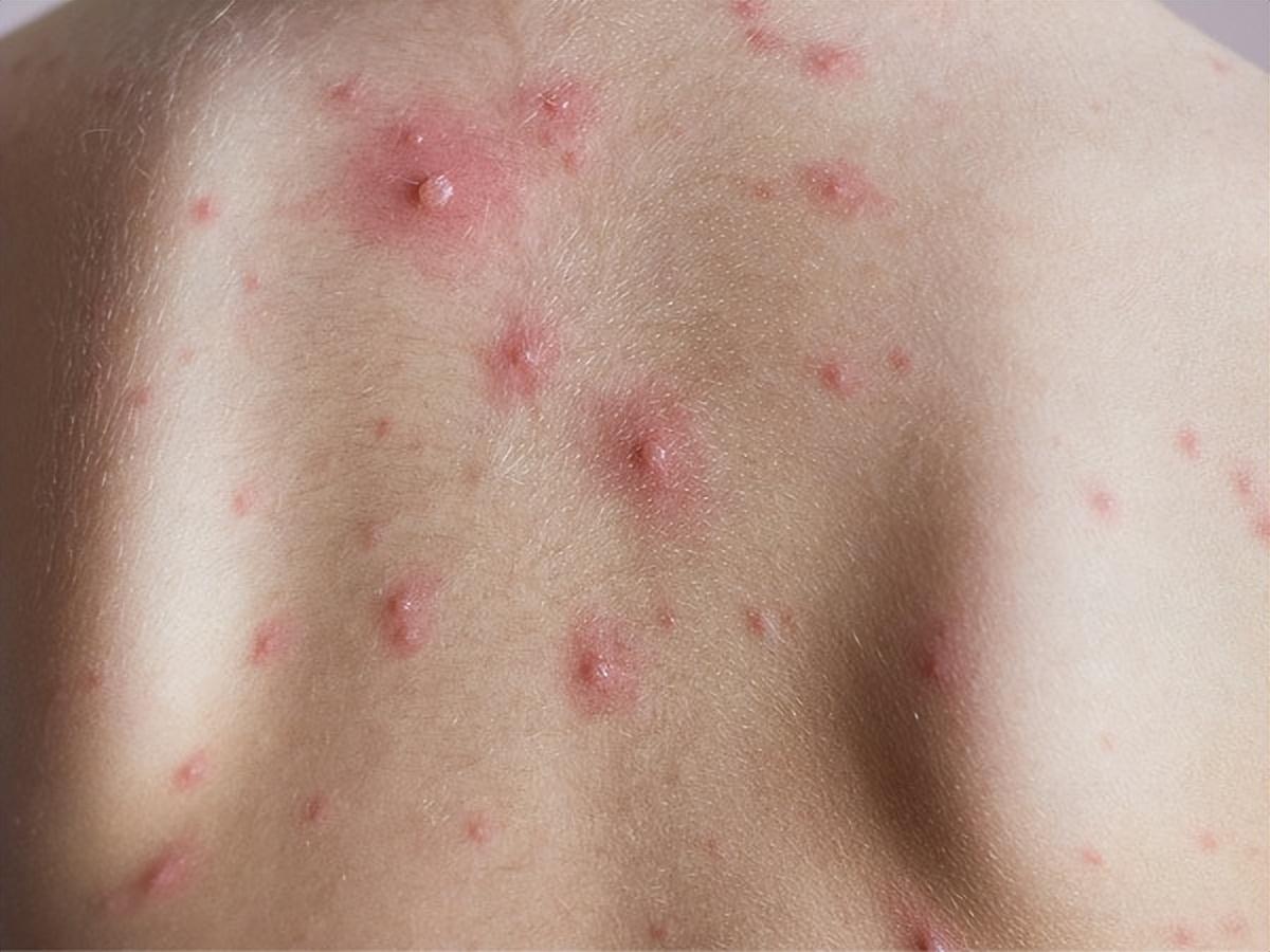 什么情况下该警惕系统性红斑狼疮?