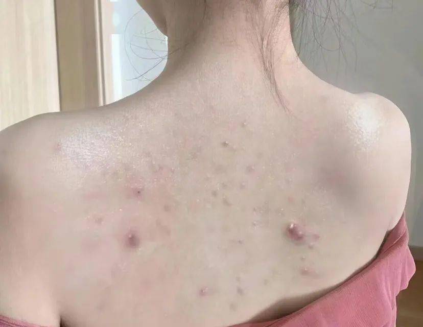 100年国货老牌,液体硫磺皂爆火!"60秒"揪出千万螨虫!全身嫩乎乎!