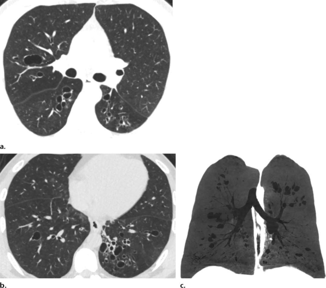 15种支气管扩张病因的影像学表现│以影识病