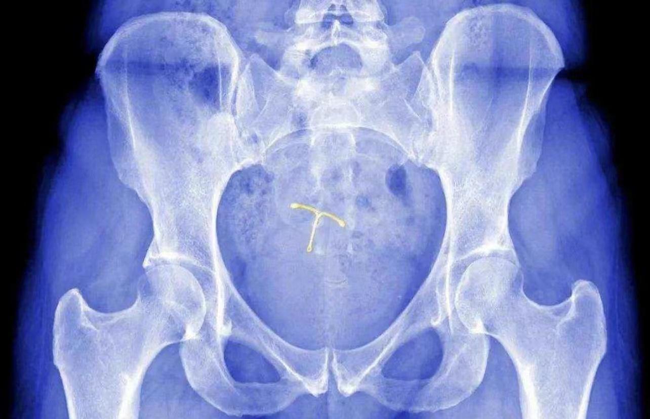 最后吗,节育环超期还肯引起环周息肉,这种情况是由于节育环超期使用对