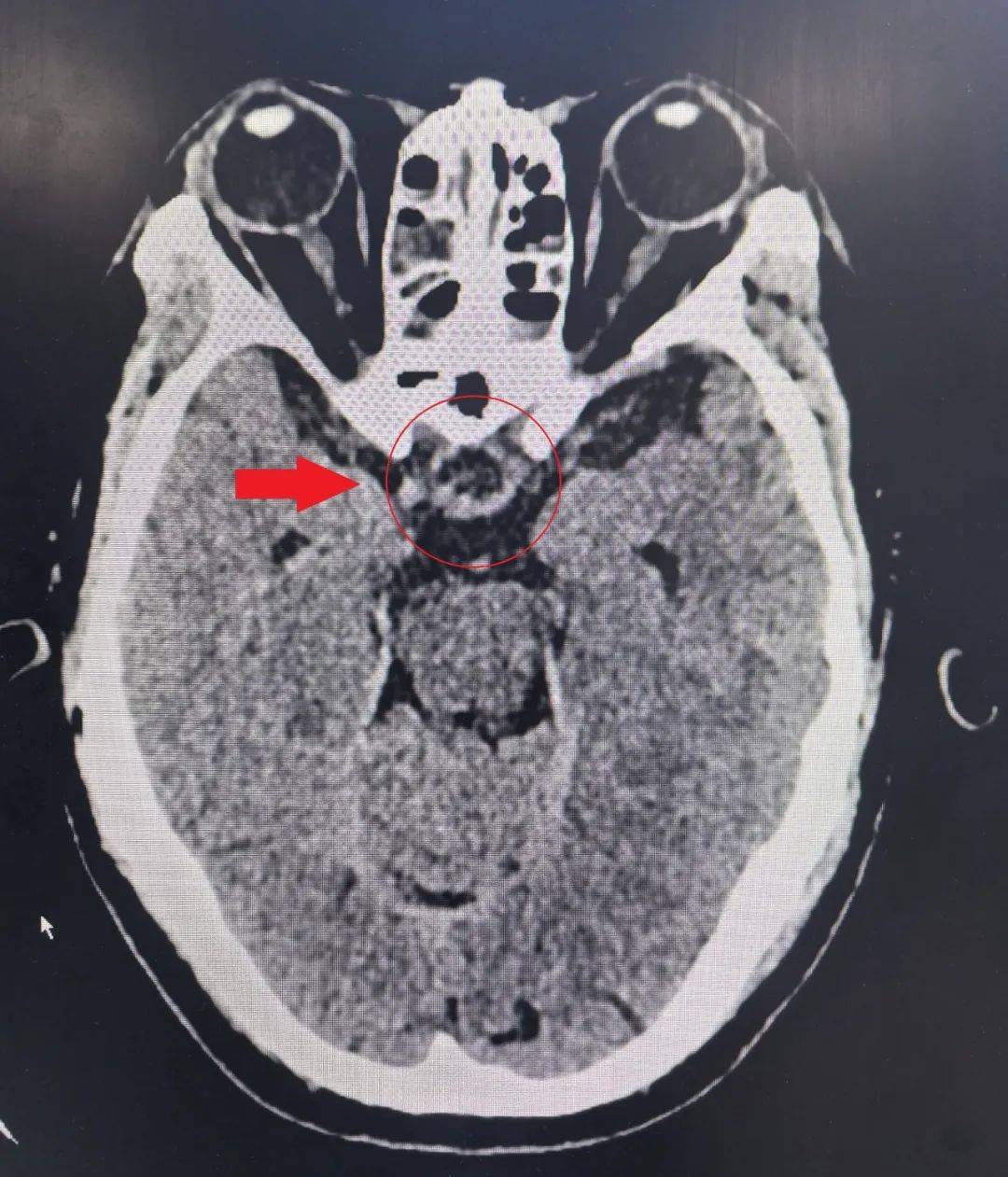 西安医学院一附院多学科联合救治一例复杂垂体瘤卒中患者