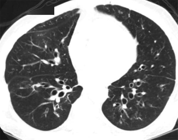 15种支气管扩张病因的影像学表现│以影识病