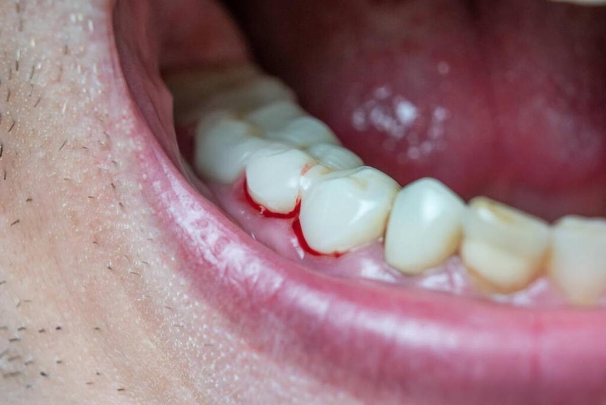 牙龈白化、「翠绿色瘤」……奇葩的白血病浸润症状，你见过？_医学界-助力医生临床决策和职业成长