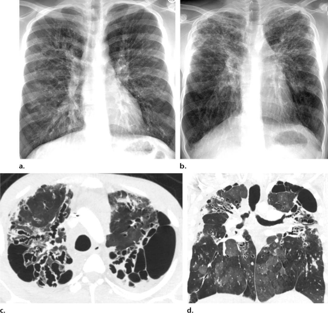 15种支气管扩张病因的影像学表现│以影识病