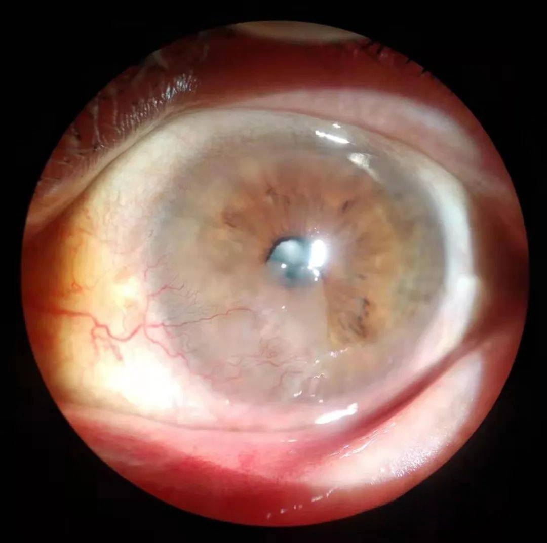眼科图谱100张 | 裂隙灯下眼科图片分享