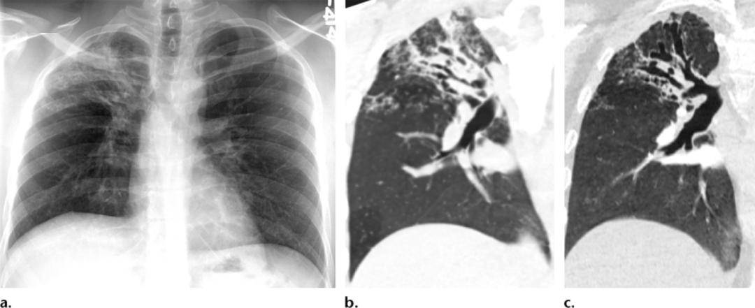 15种支气管扩张病因的影像学表现│以影识病