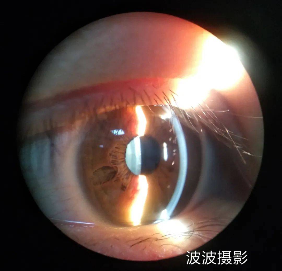 眼科图谱100张 | 裂隙灯下眼科图片分享