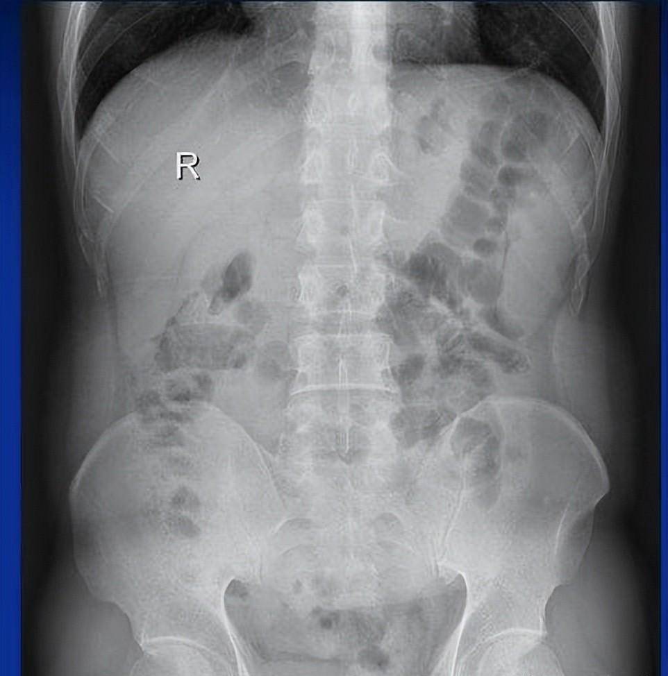 肠梗阻腹平片图片