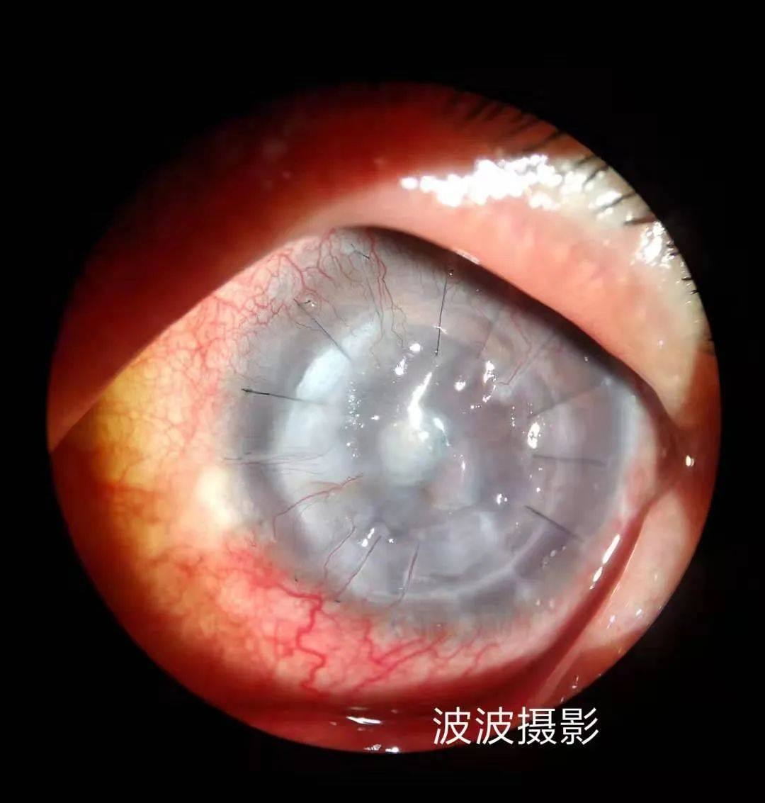 眼科图谱100张 | 裂隙灯下眼科图片分享