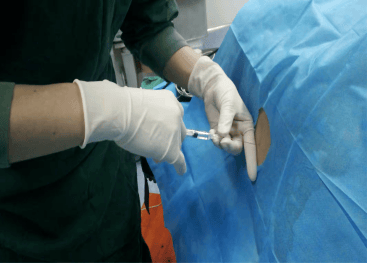 科普:椎管内麻醉会引起腰疼吗?