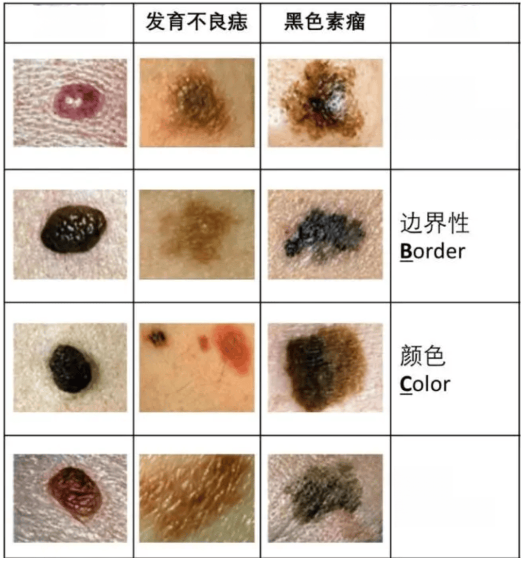 屁股下方长痣图片