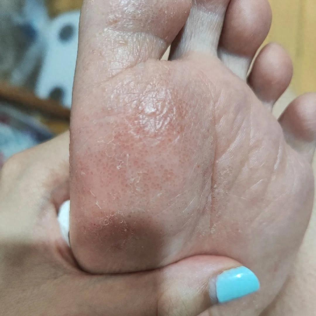 中医说:汗疱疹是身体在预警