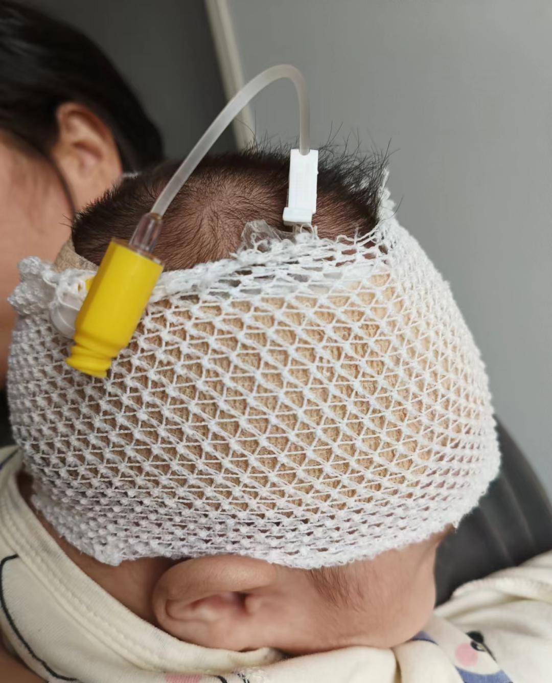 留置针脱管,为了减少患儿反复穿刺的几率,呼市妇幼保健院儿科使用弹力