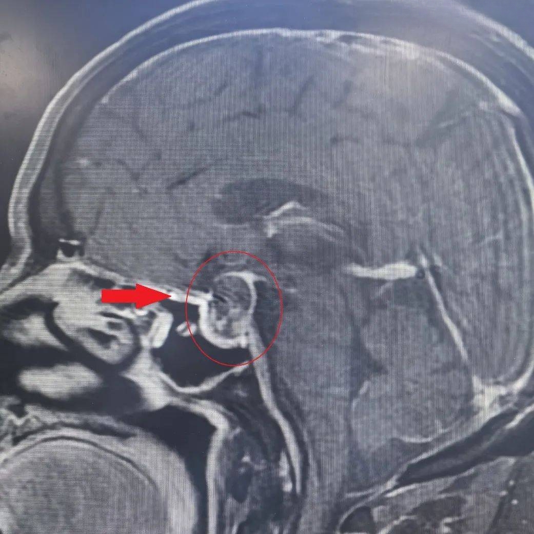 西安医学院一附院多学科联合救治一例复杂垂体瘤卒中患者