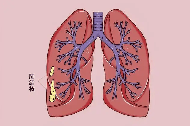 【小南话科普】世界肺结核日丨确诊肺结核"救星"——电子支气管镜肺泡