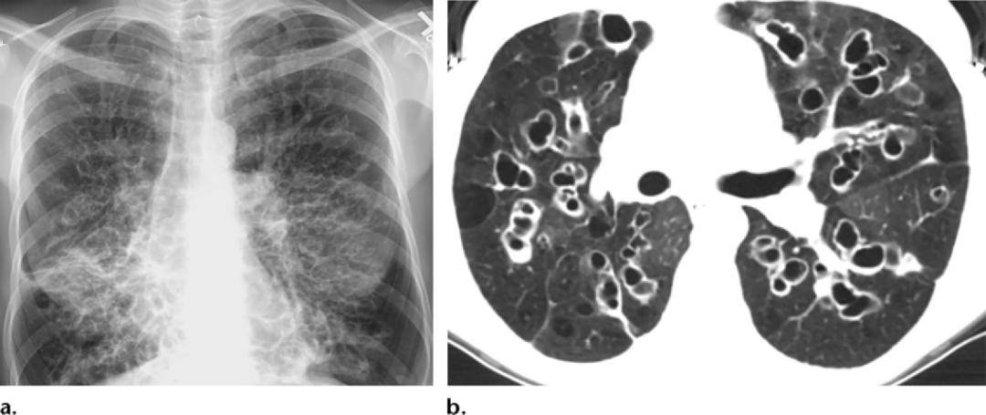 (a)后前位x线显示平行分布的分支线状影(轨道征),代表支气管扩张.