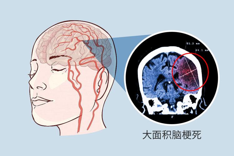 脑梗死位置图图片