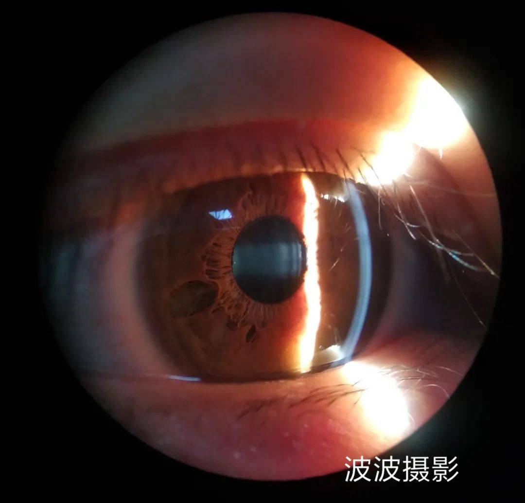 眼科图谱100张 | 裂隙灯下眼科图片分享