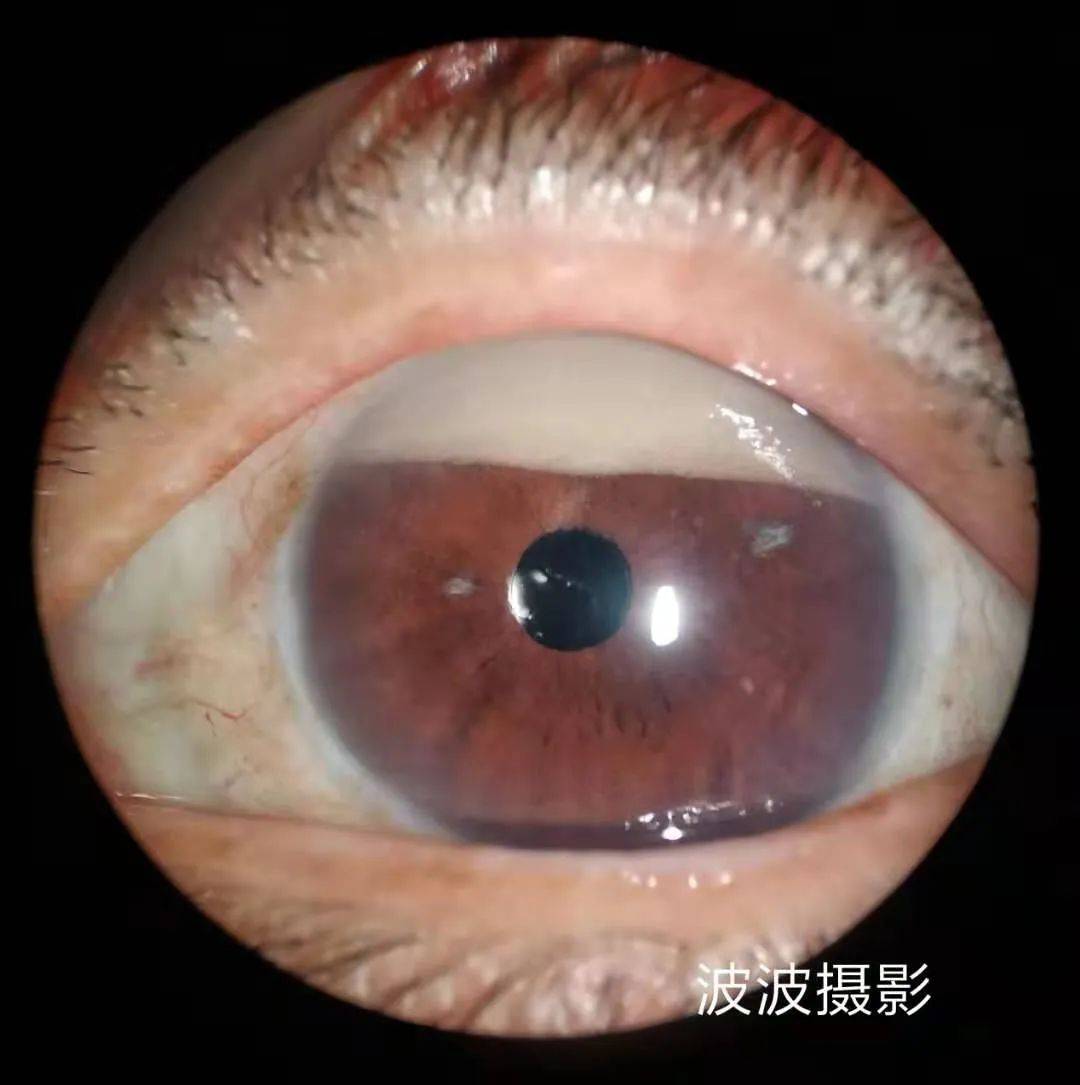 眼科图谱100张 | 裂隙灯下眼科图片分享