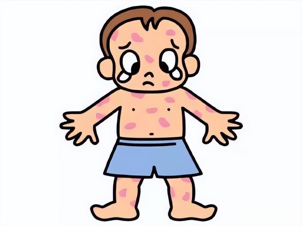 猩红热为a群溶血性链球菌感染引起的急性呼吸道传染病,潜伏期1