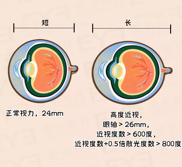 十大高度近视眼图片图片