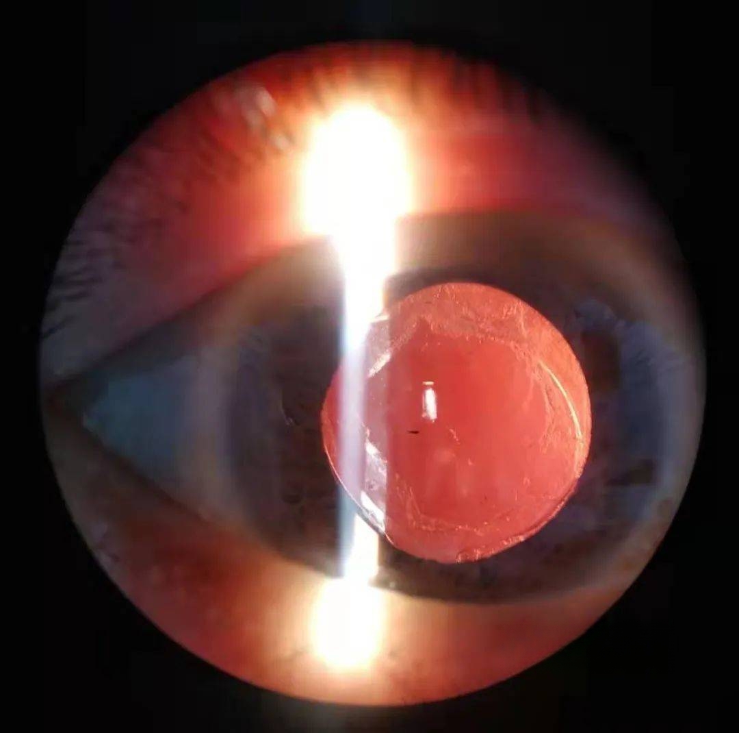 眼科图谱100张 | 裂隙灯下眼科图片分享