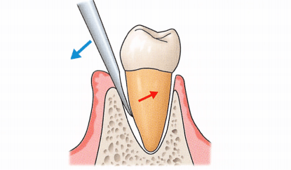 牙挺拔牙的技巧,这篇文章总结全了!