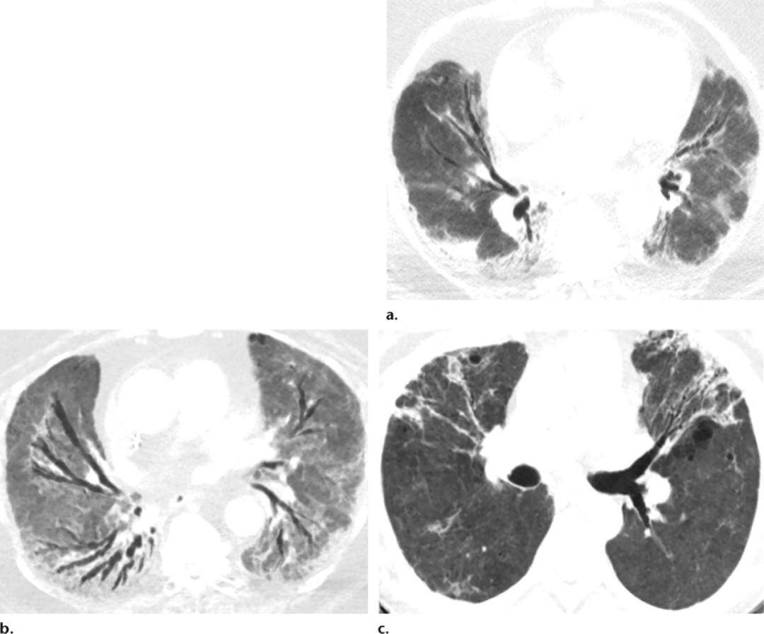 (a)就诊数天后横断面ct显示轻度柱状支气管扩张.