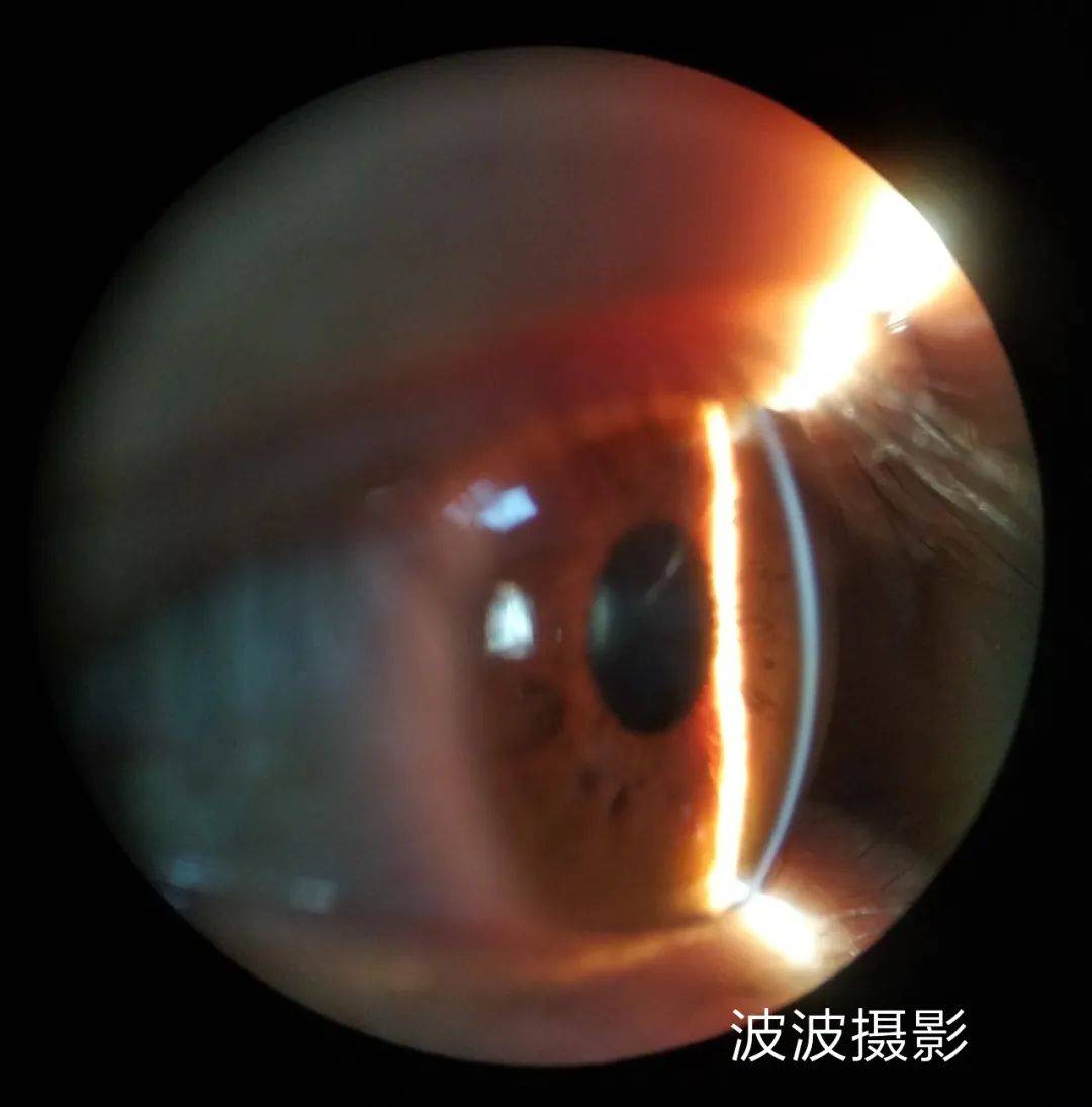 眼科图谱100张 | 裂隙灯下眼科图片分享