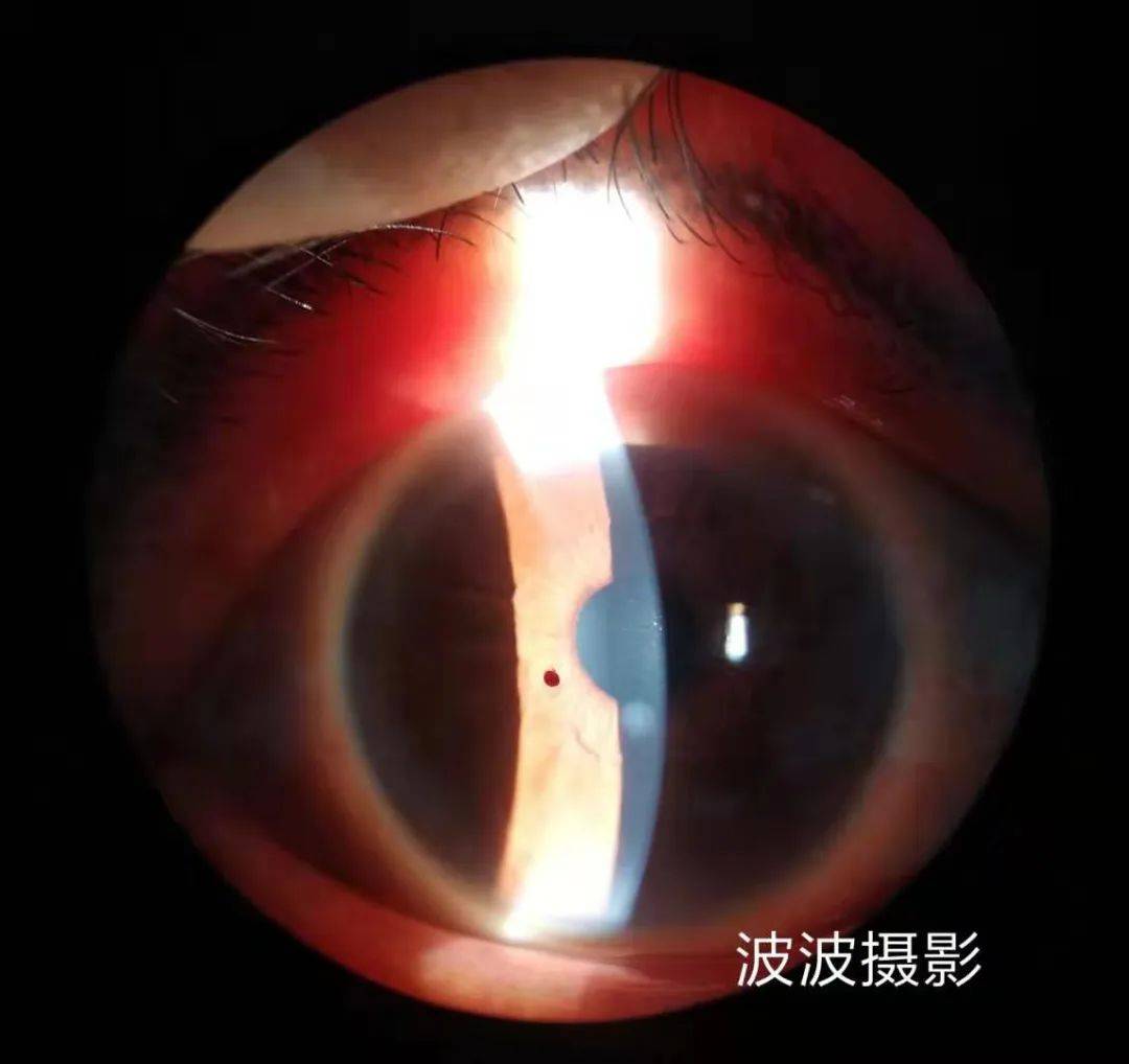 眼科图谱100张 | 裂隙灯下眼科图片分享