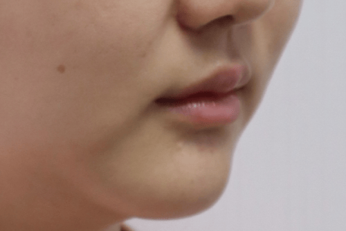 北京西美姜美主任:不同类型的木偶纹,怎么改善?