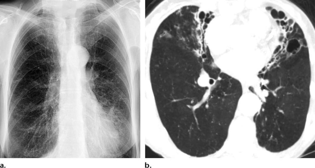 15种支气管扩张病因的影像学表现│以影识病