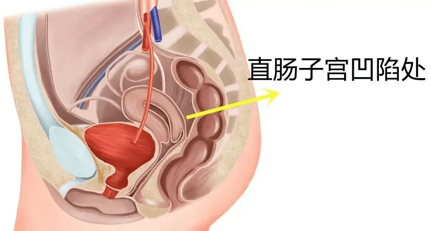 腹膜腔 子宮