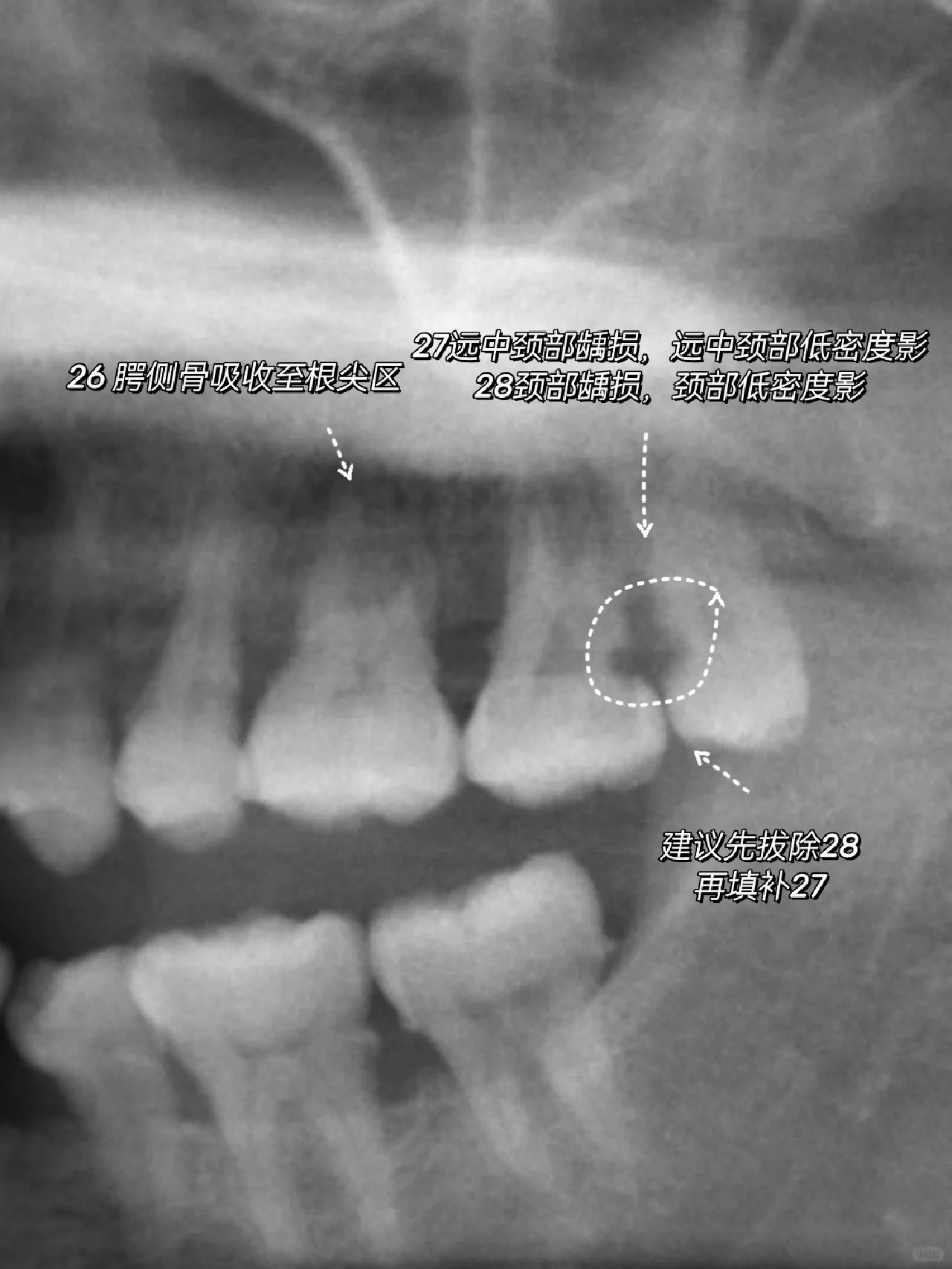 牙槽骨的质和量是种植牙成功的关键！一例种植牙前牙槽骨修复手术-刘筱佳主治医师-爱问医生
