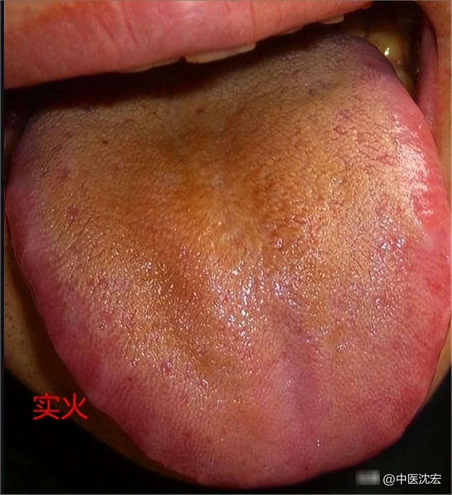 舌头颜色发红,那证明你体内有火,不过中医认为,火有两种,分别是实火和
